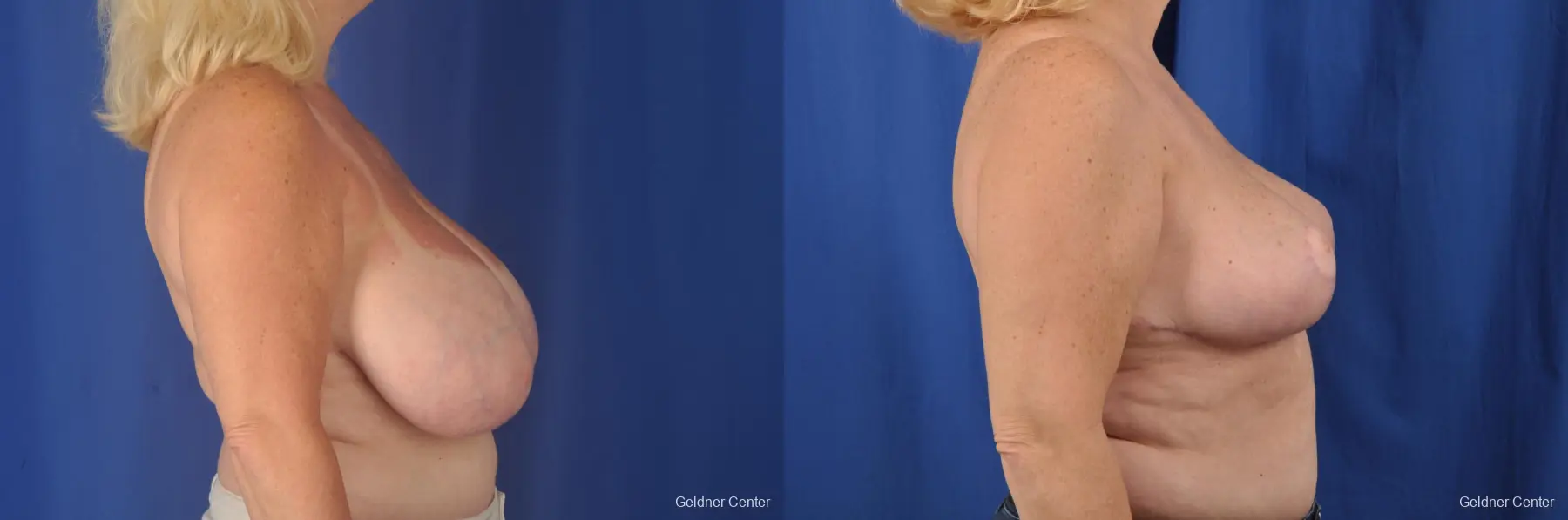 Breast Reduction: Patient 28 - Before and After 3
