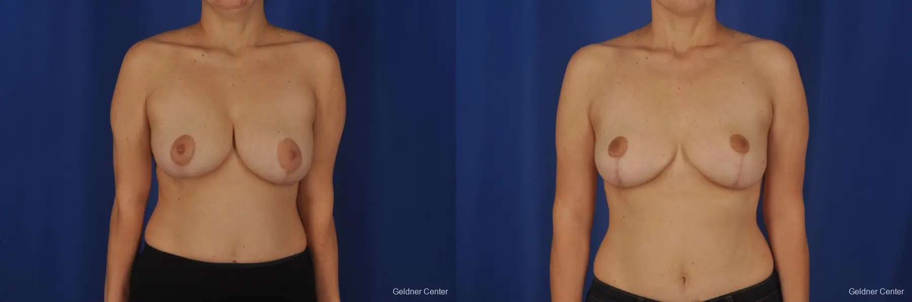 Chicago Breast Reduction 2068 - Before and After