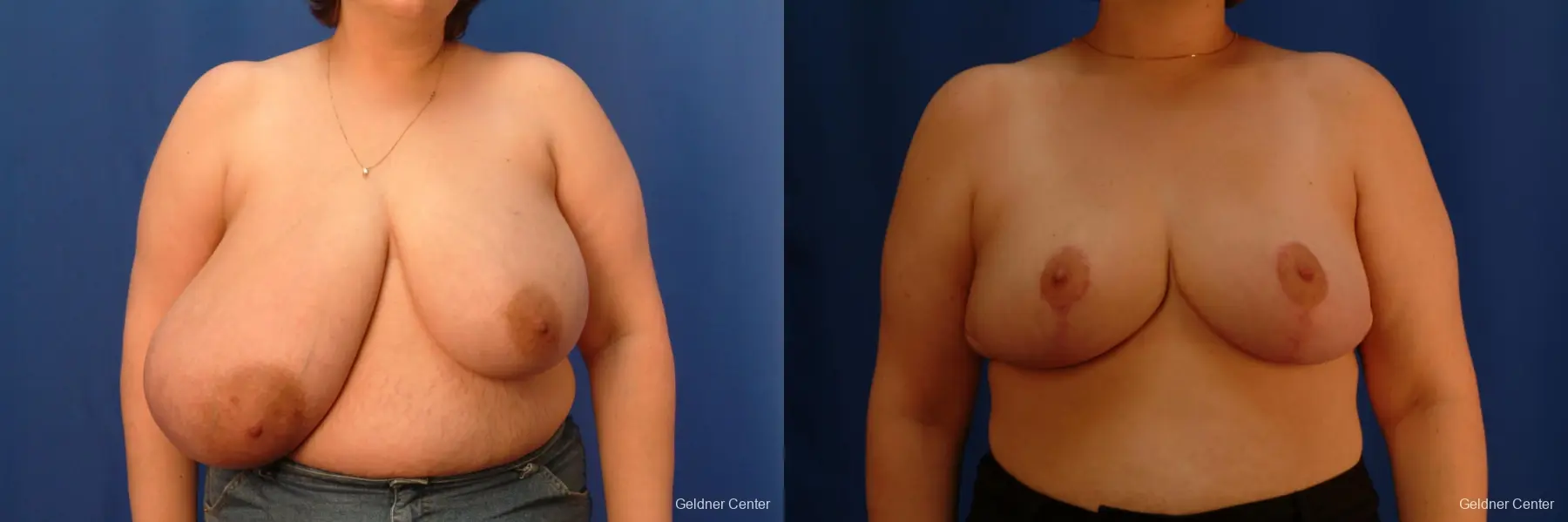 Breast Reduction Streeterville, Chicago 2522 - Before and After