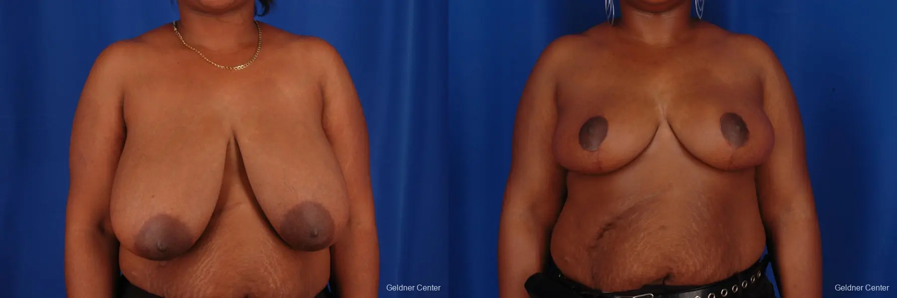 Breast Reduction Hinsdale, Chicago 2334 - Before and After