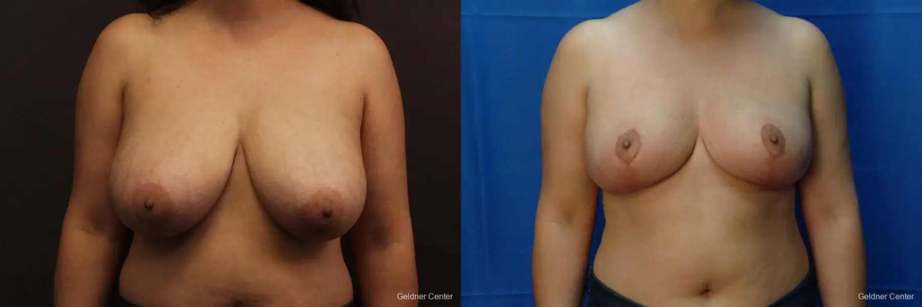 Chicago Breast Reduction 2416 - Before and After