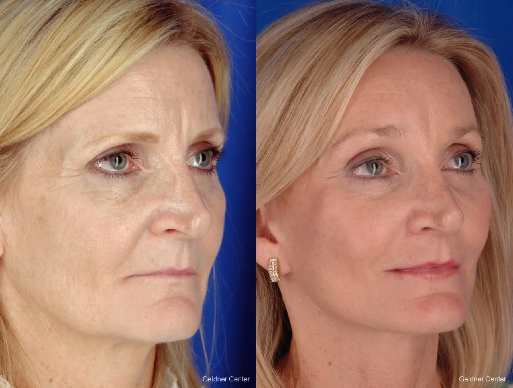 Chicago Brow Lift 2285 - Before and After 3