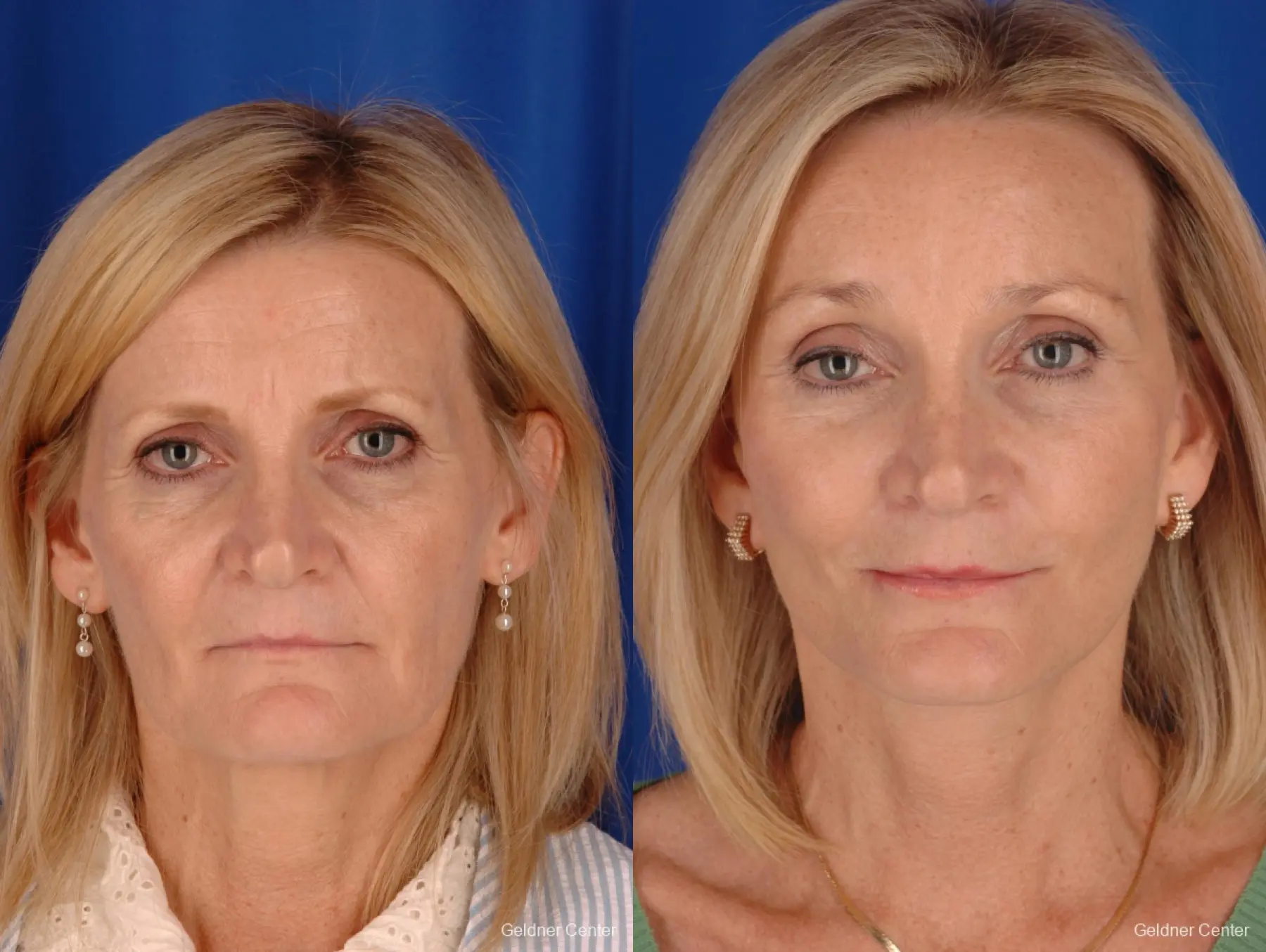 Chicago Brow Lift 2285 - Before and After 1