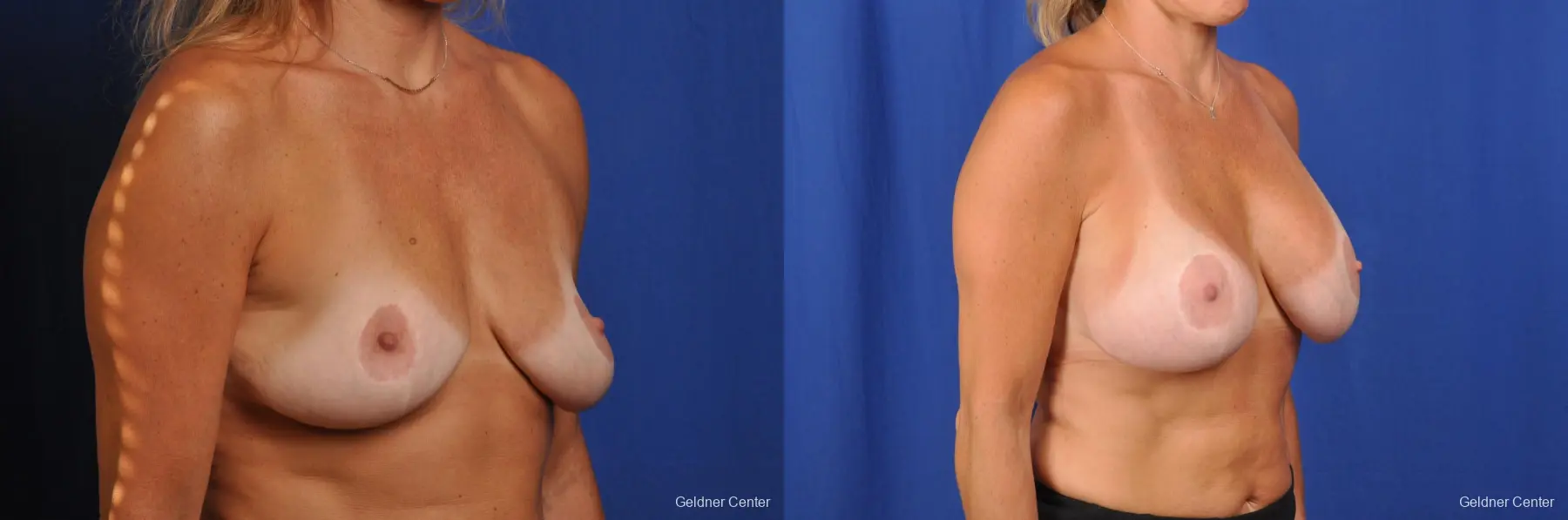 Complex Breast Augmentation Streeterville, Chicago 2392 - Before and After 3