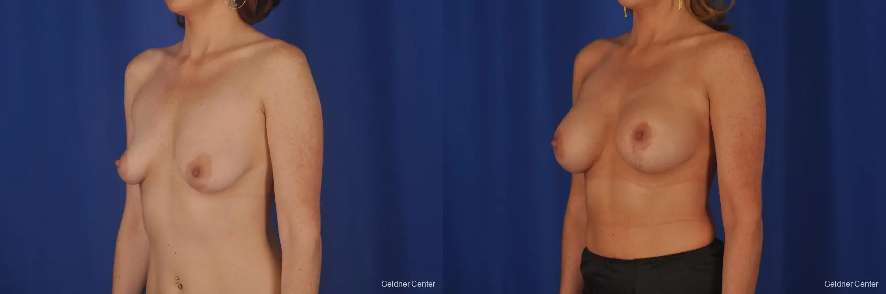 Chicago Complex Breast Augmentation 2400 - Before and After 3