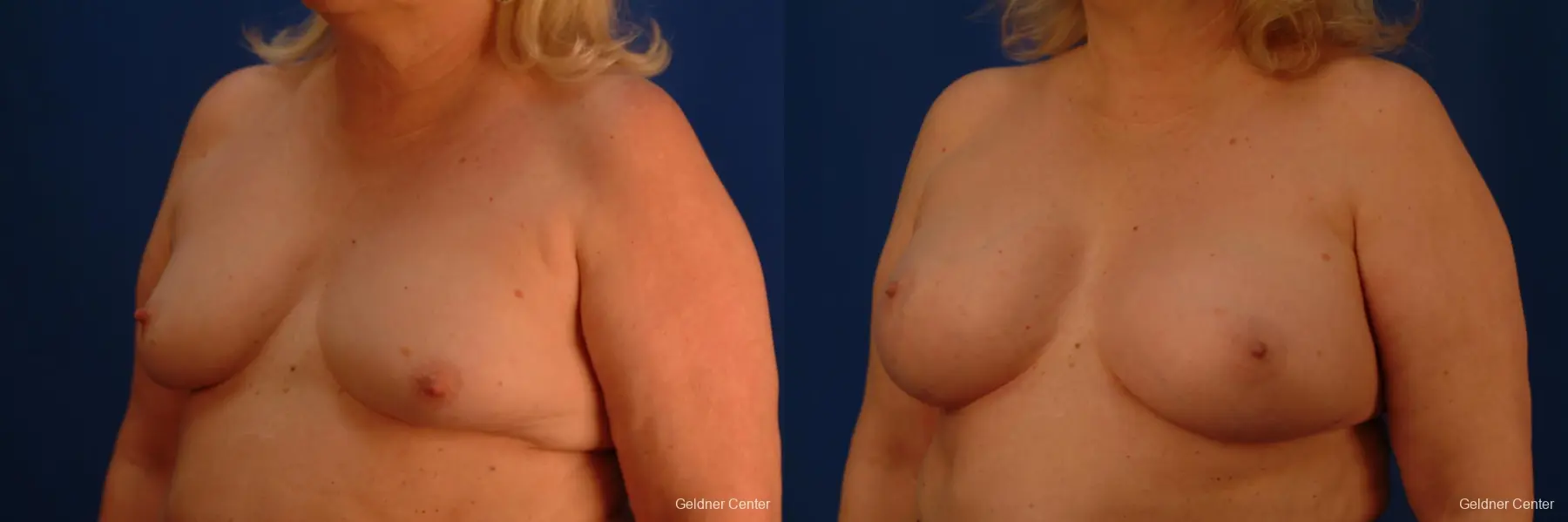 Complex Breast Augmentation Hinsdale, Chicago 2430 - Before and After 4