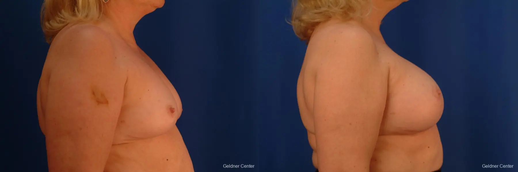 Complex Breast Augmentation Hinsdale, Chicago 2430 - Before and After 2