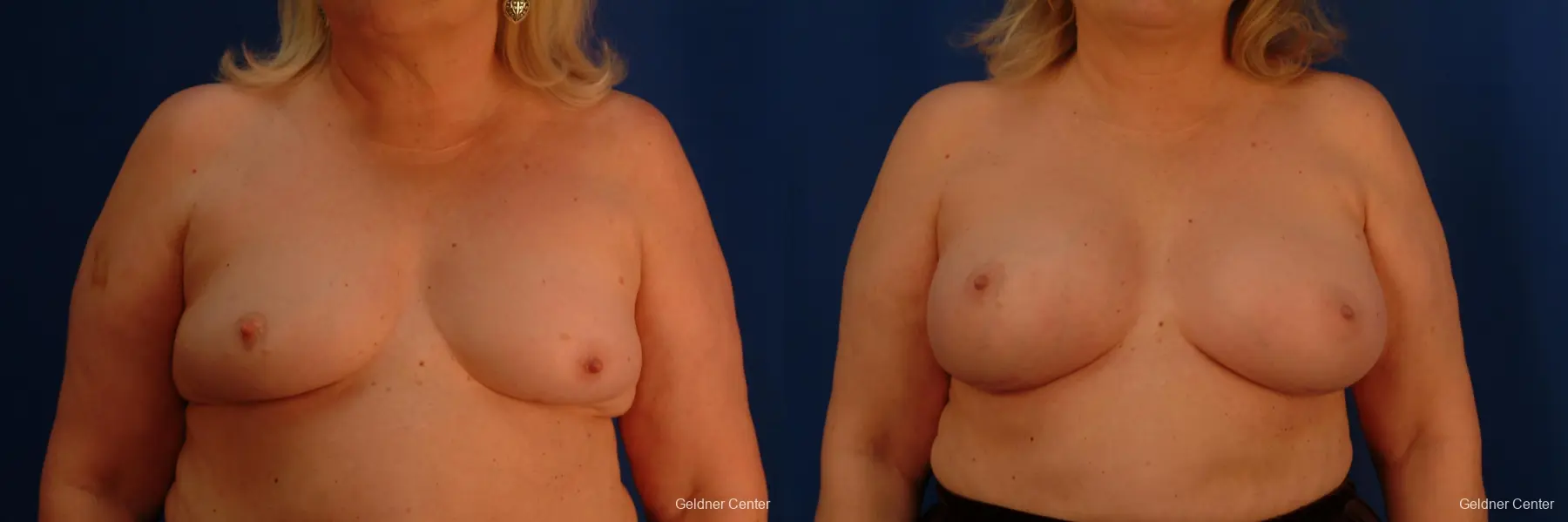 Complex Breast Augmentation Hinsdale, Chicago 2430 - Before and After 1