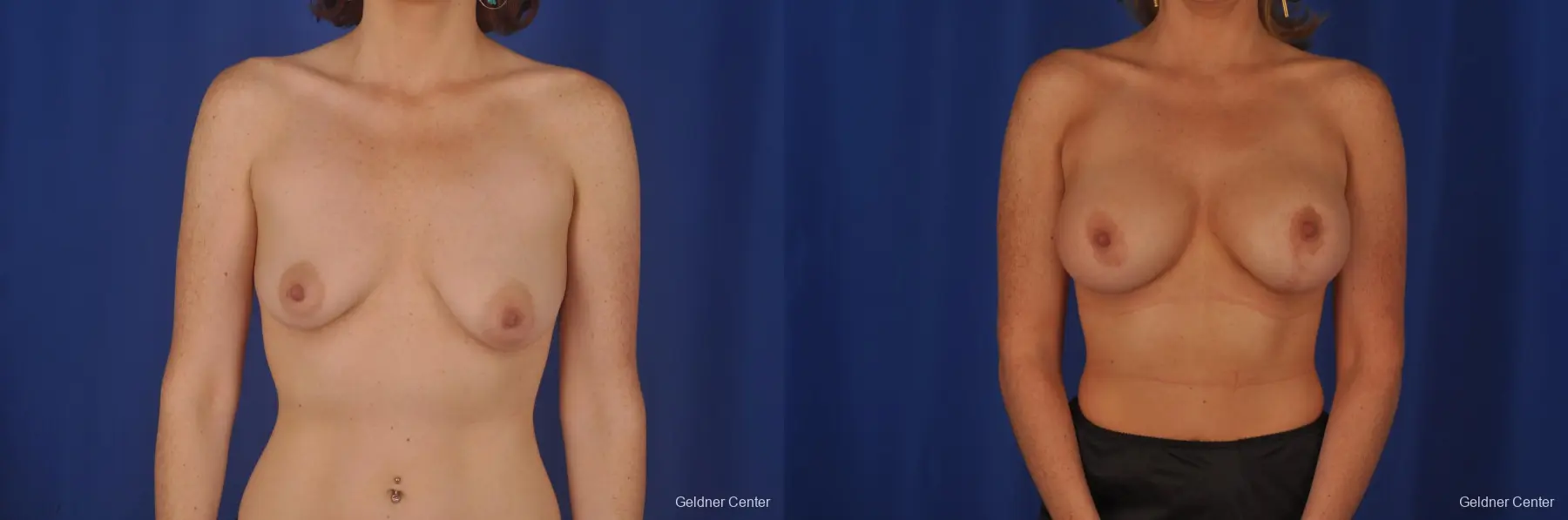 Chicago Complex Breast Augmentation 2400 - Before and After 1