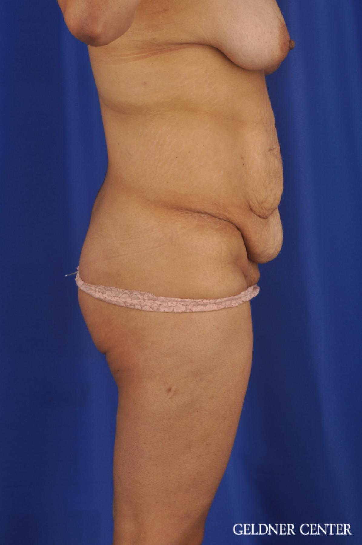 Tummy Tuck: Patient 33 - Before 3