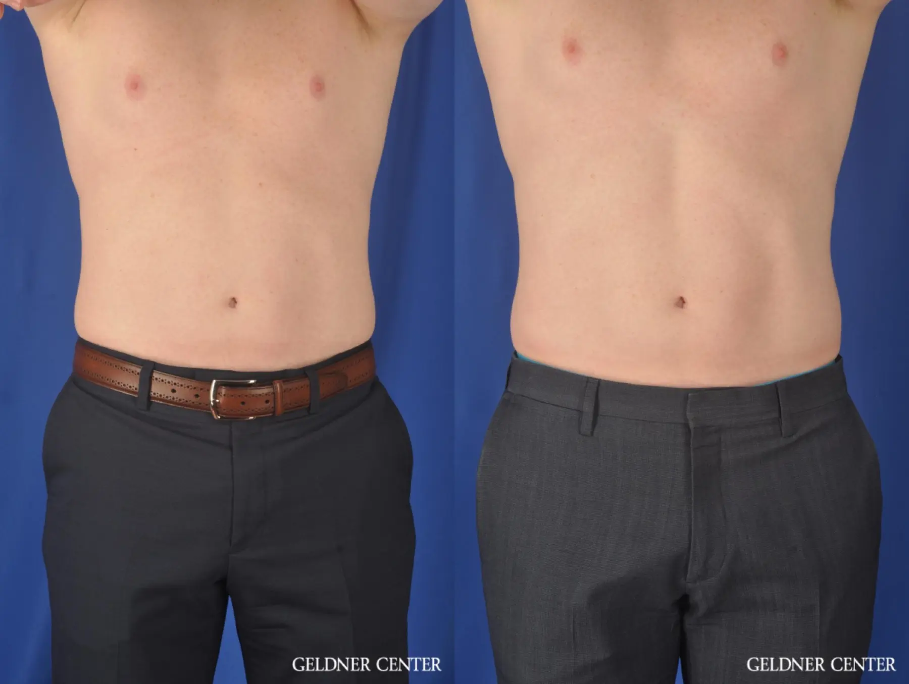 Emsculpt-for-men: Patient 1 - Before and After 