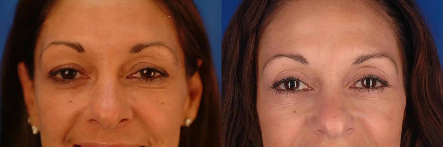 49 year old woman, four lid blepharoplasty - Before and After