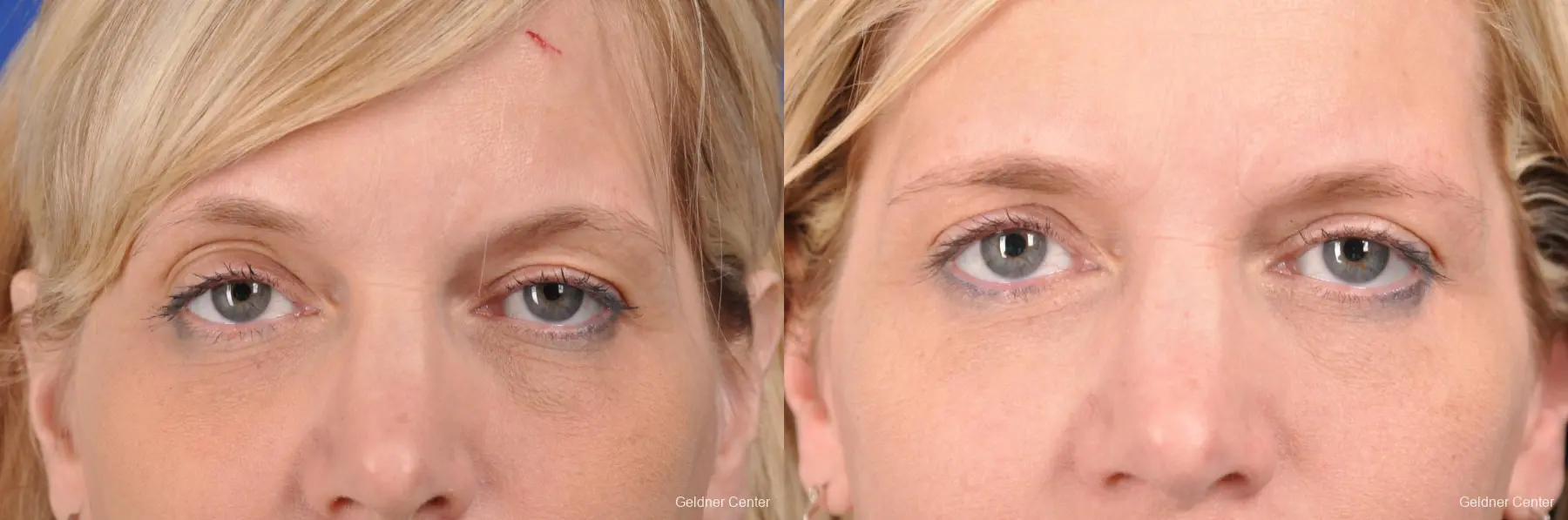 fat from all three fat pockets, lower blepharoplasty - Before and After