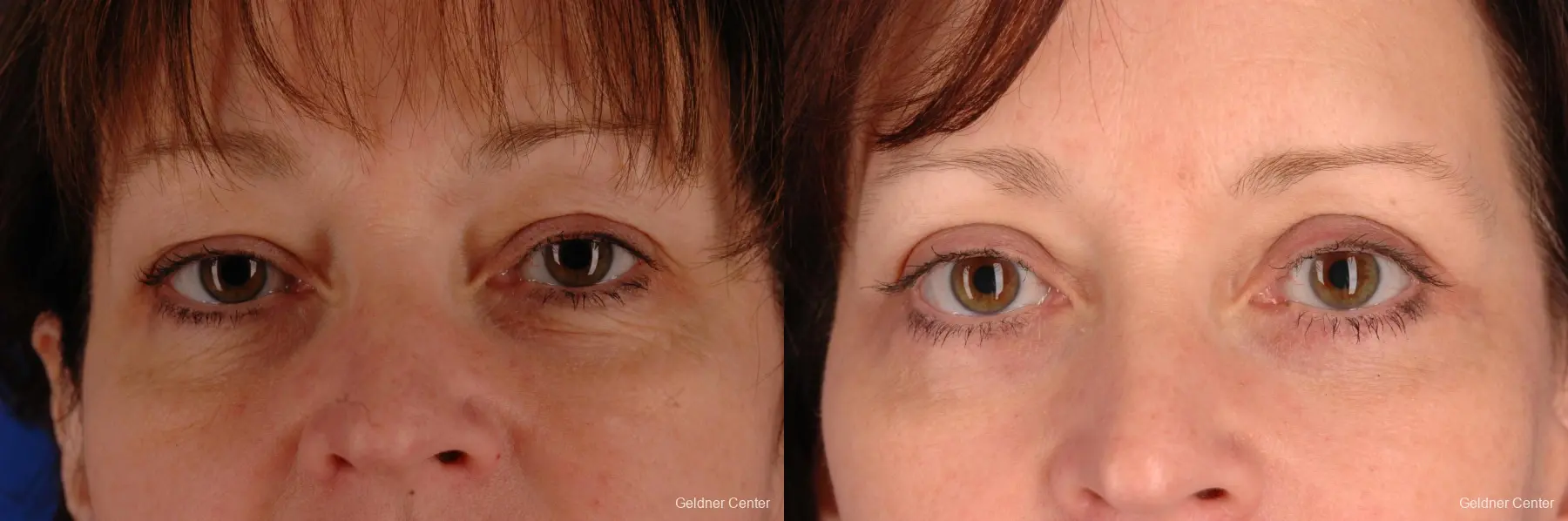 52 year old woman, lower blepharoplasty - Before and After