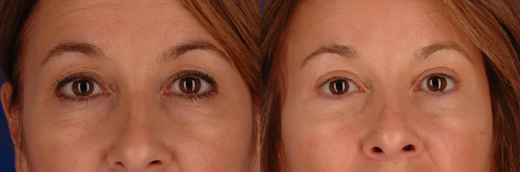 42 year old woman, upper and lower blepharoplasty - Before and After