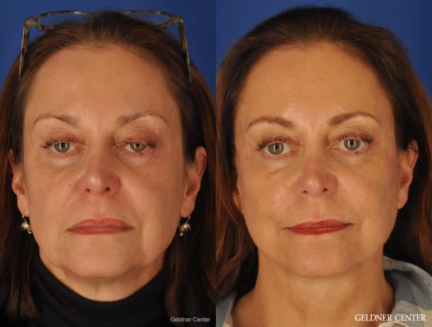 SMAS Facelift with Platysmaplasty - Before and After
