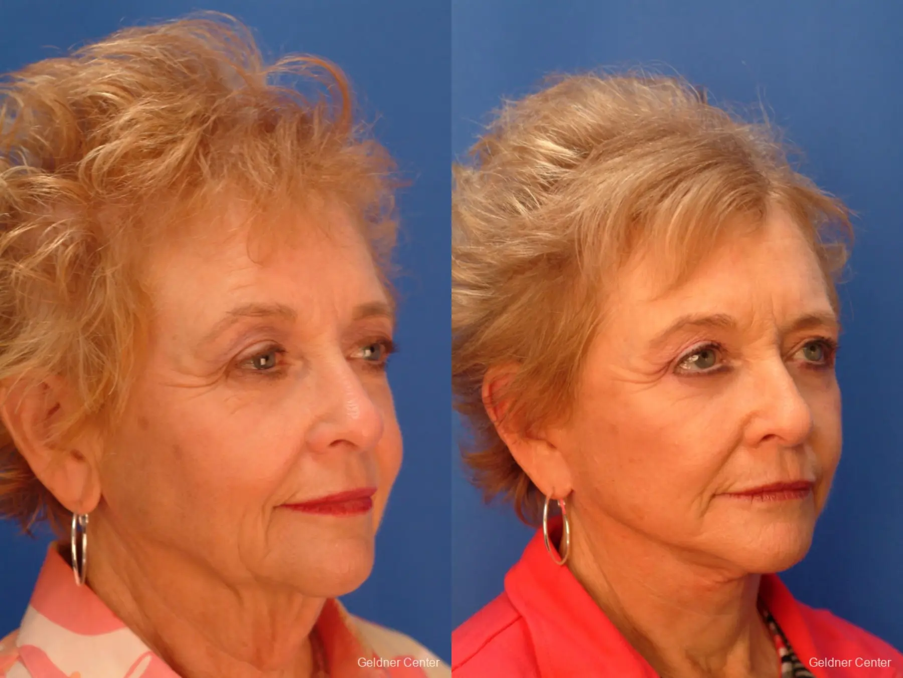 Facelift: Patient 7 - Before and After 3