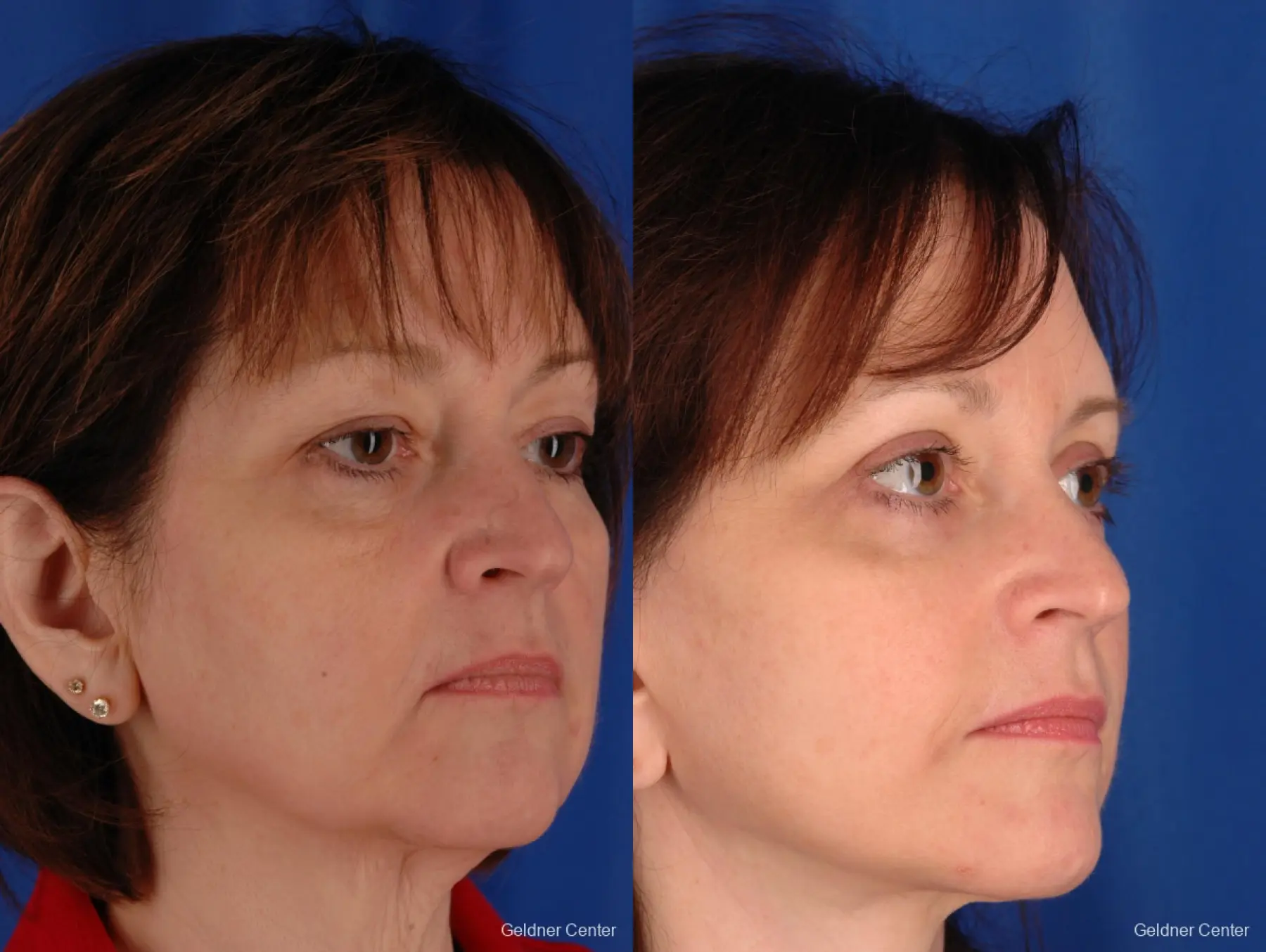 Facelift: Patient 3 - Before and After 3