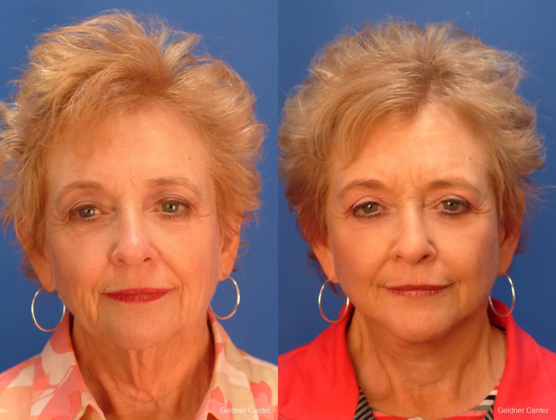 Facelift: Patient 7 - Before and After 1