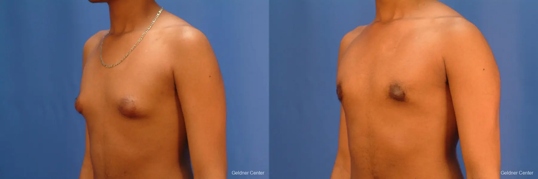 Gynecomastia: Patient 5 - Before and After 5