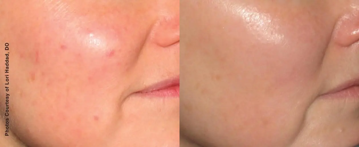 Laser: Patient 8 - Before and After 