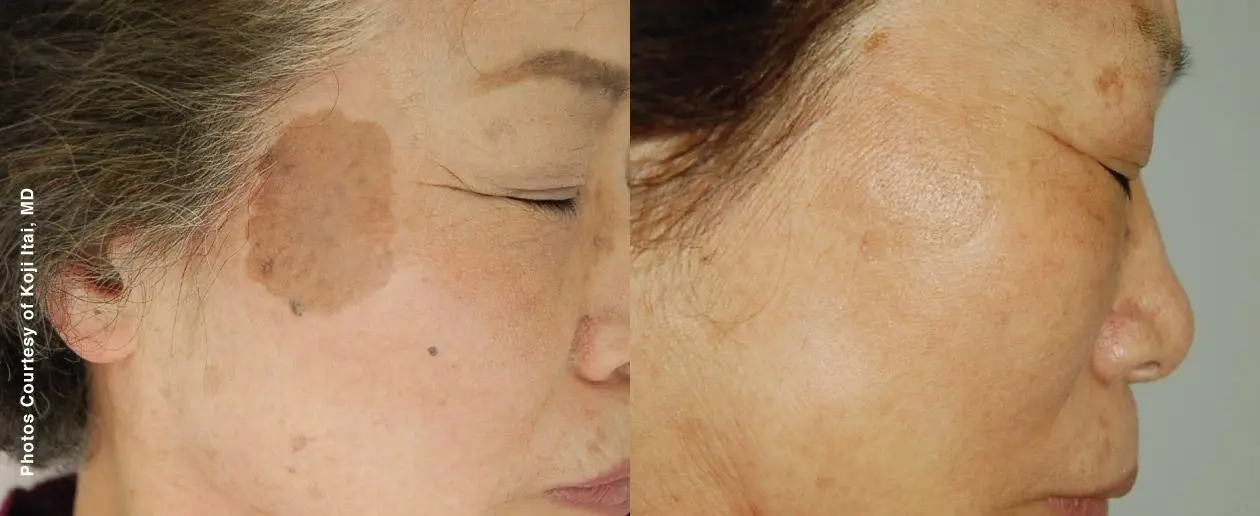 Laser: Patient 3 - Before and After 