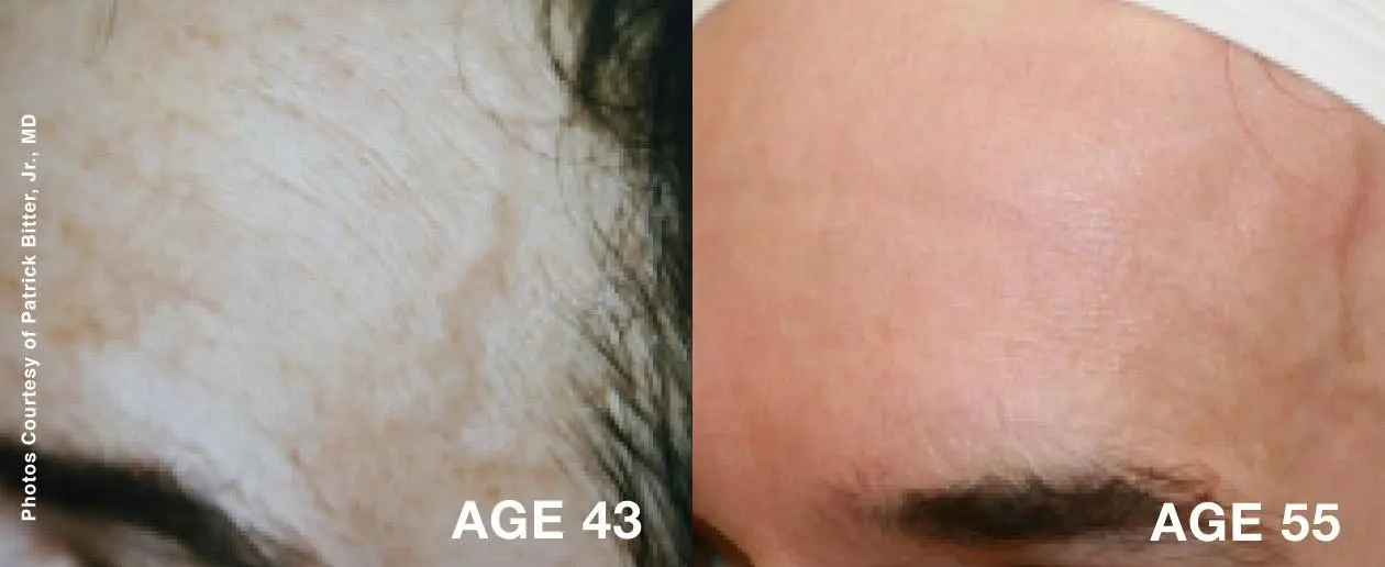 Laser: Patient 2 - Before and After 