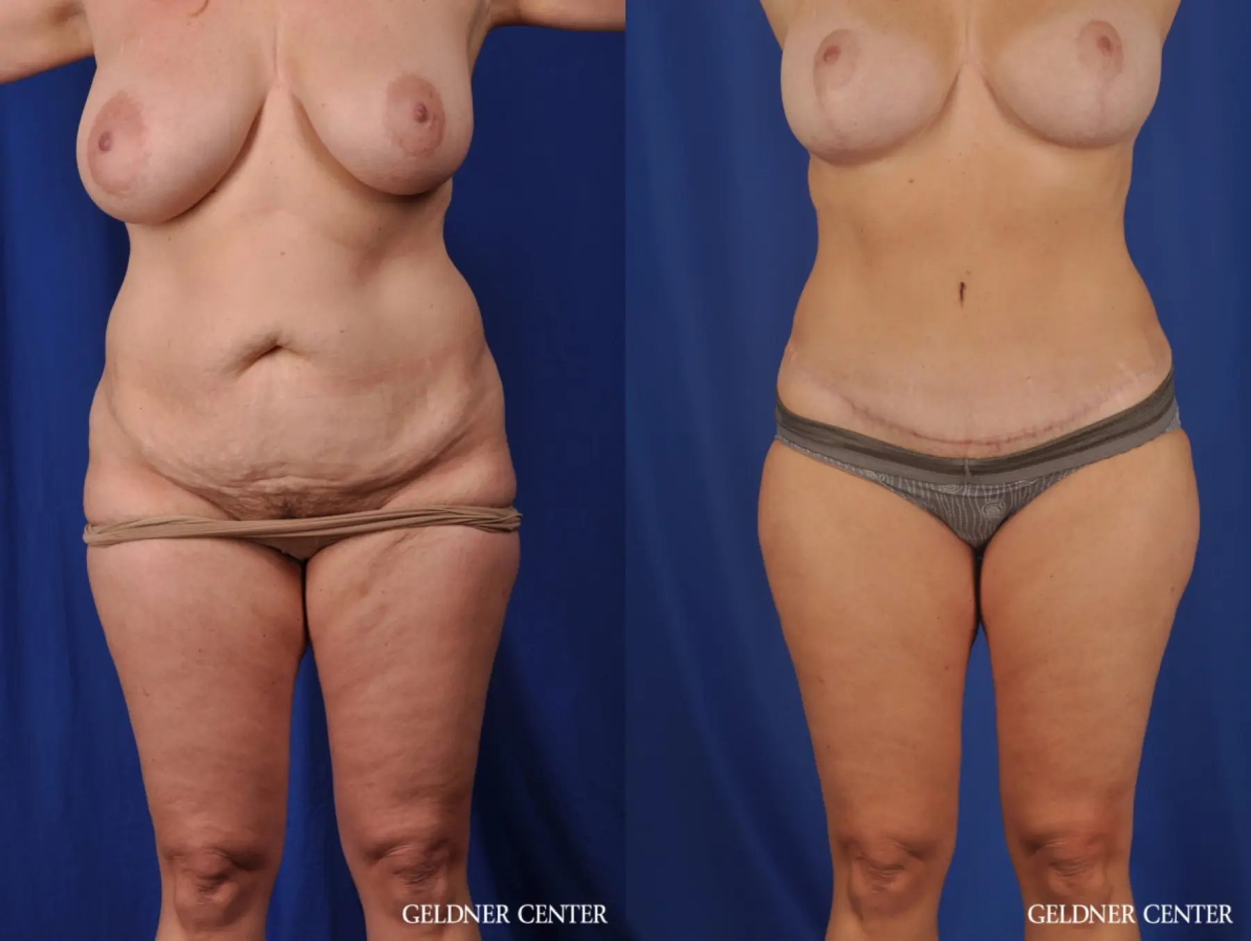 Lipoabdominoplasty: Patient 6 - Before and After 1