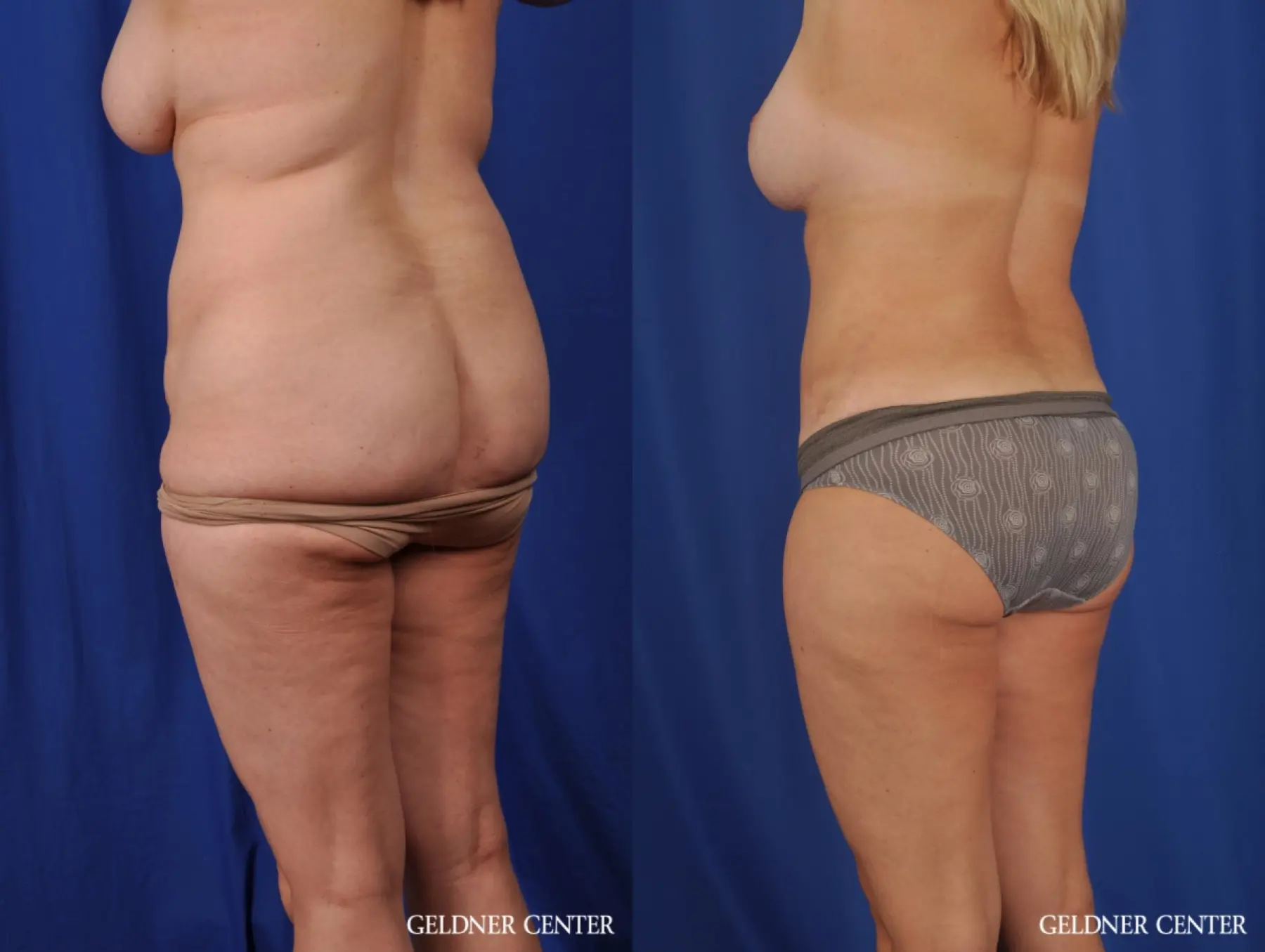 Lipoabdominoplasty: Patient 6 - Before and After 5
