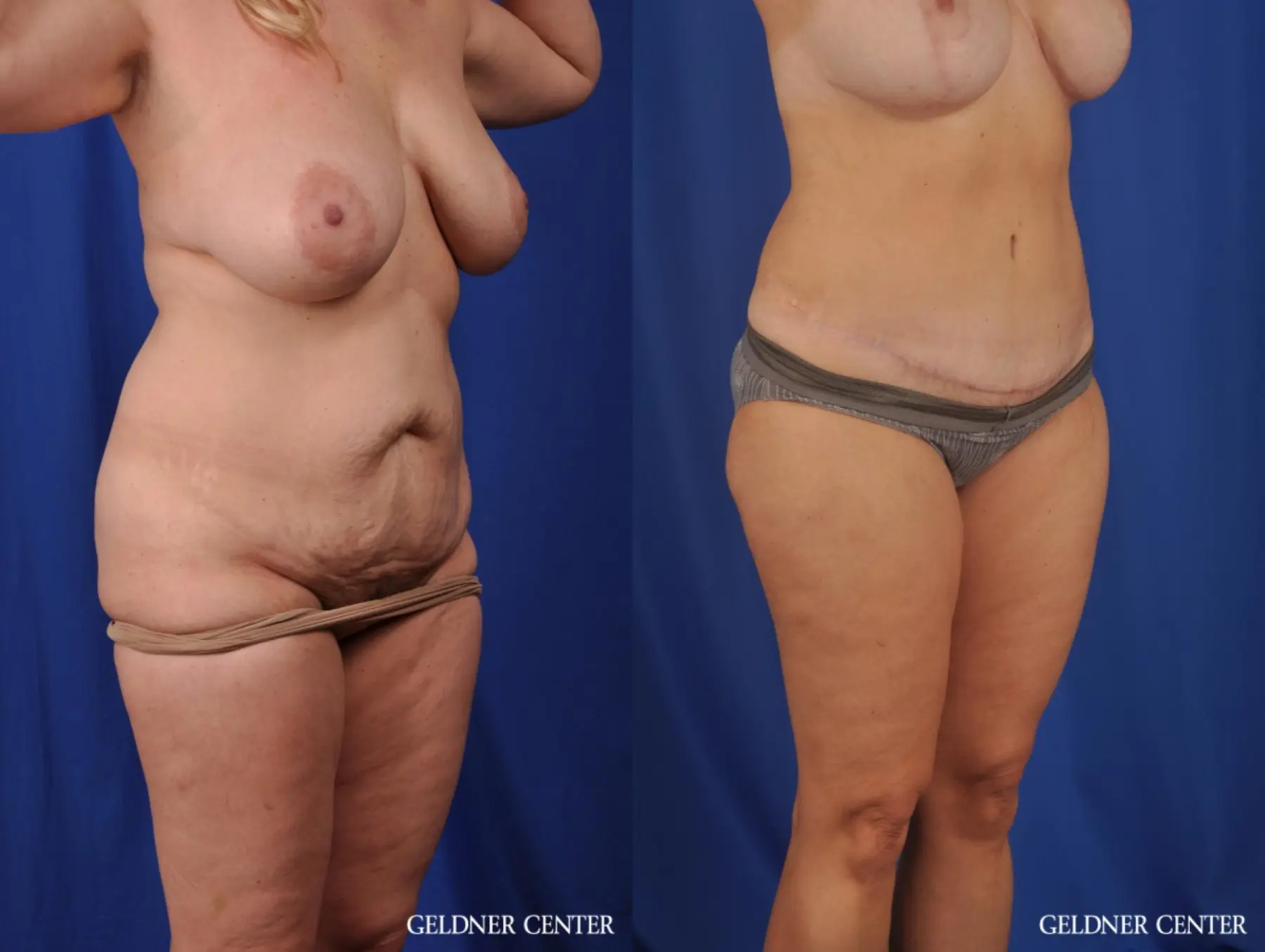Lipoabdominoplasty: Patient 6 - Before and After 2