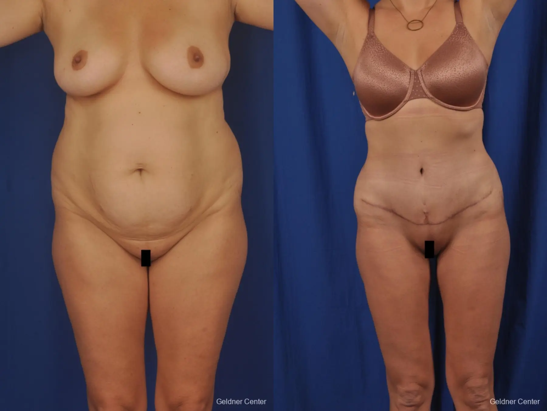 Liposuction: Patient 50 - Before and After 1