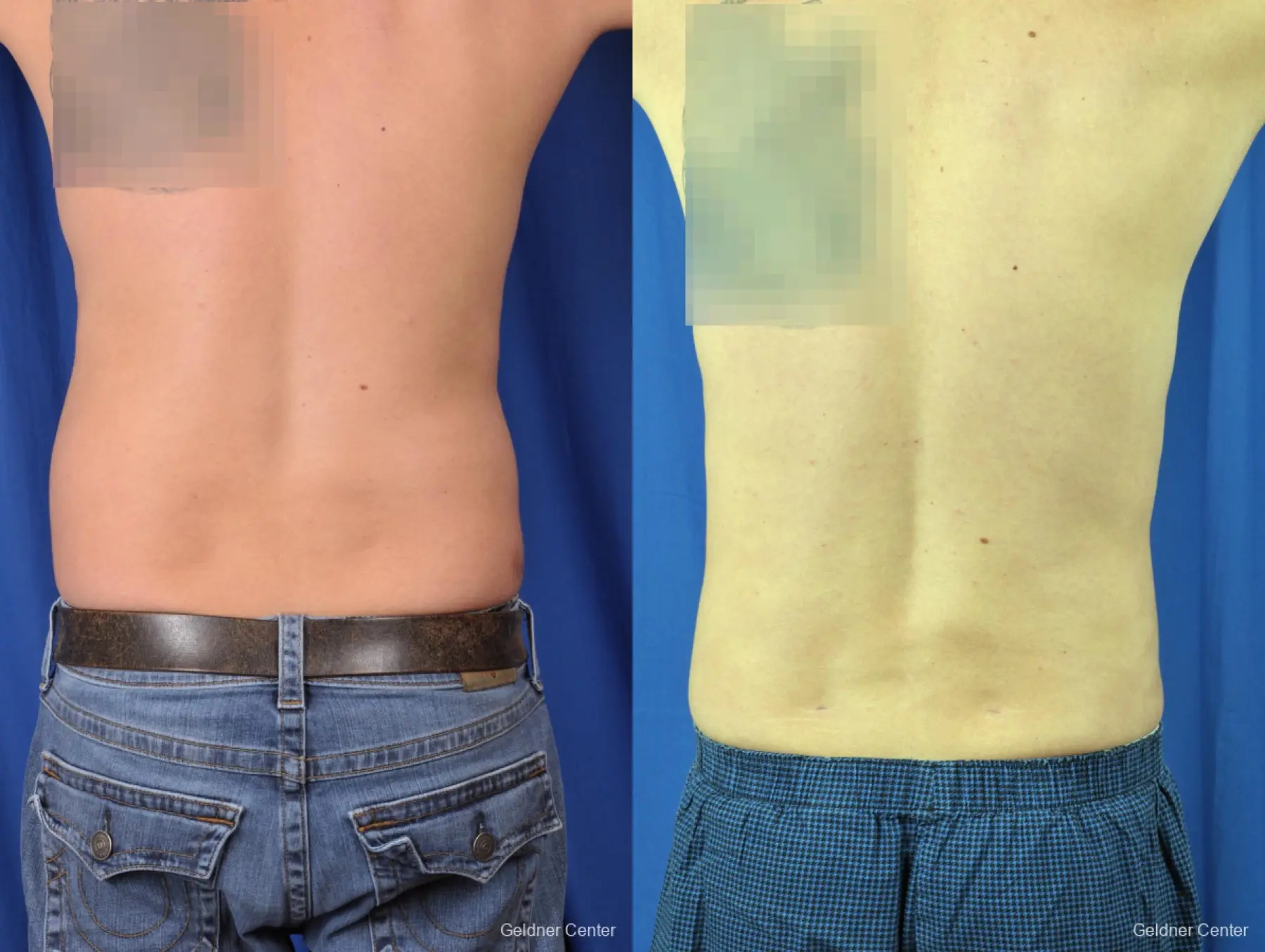 Liposuction For Men: Patient 6 - Before and After 4