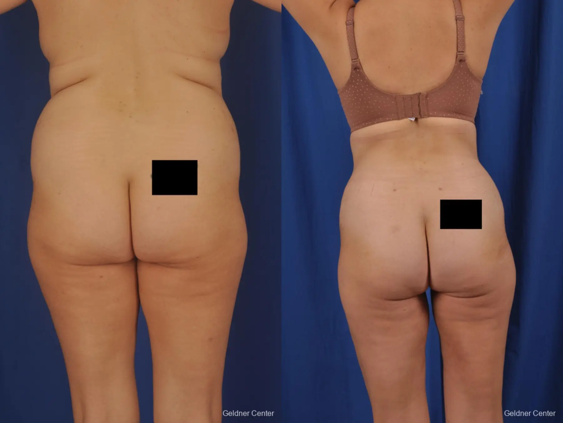 Liposuction: Patient 50 - Before and After 4