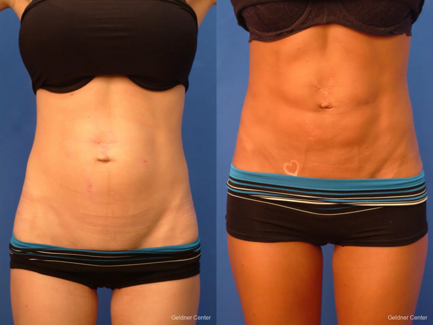  Vaser Liposuction with Abdominal Etching - Before and After 