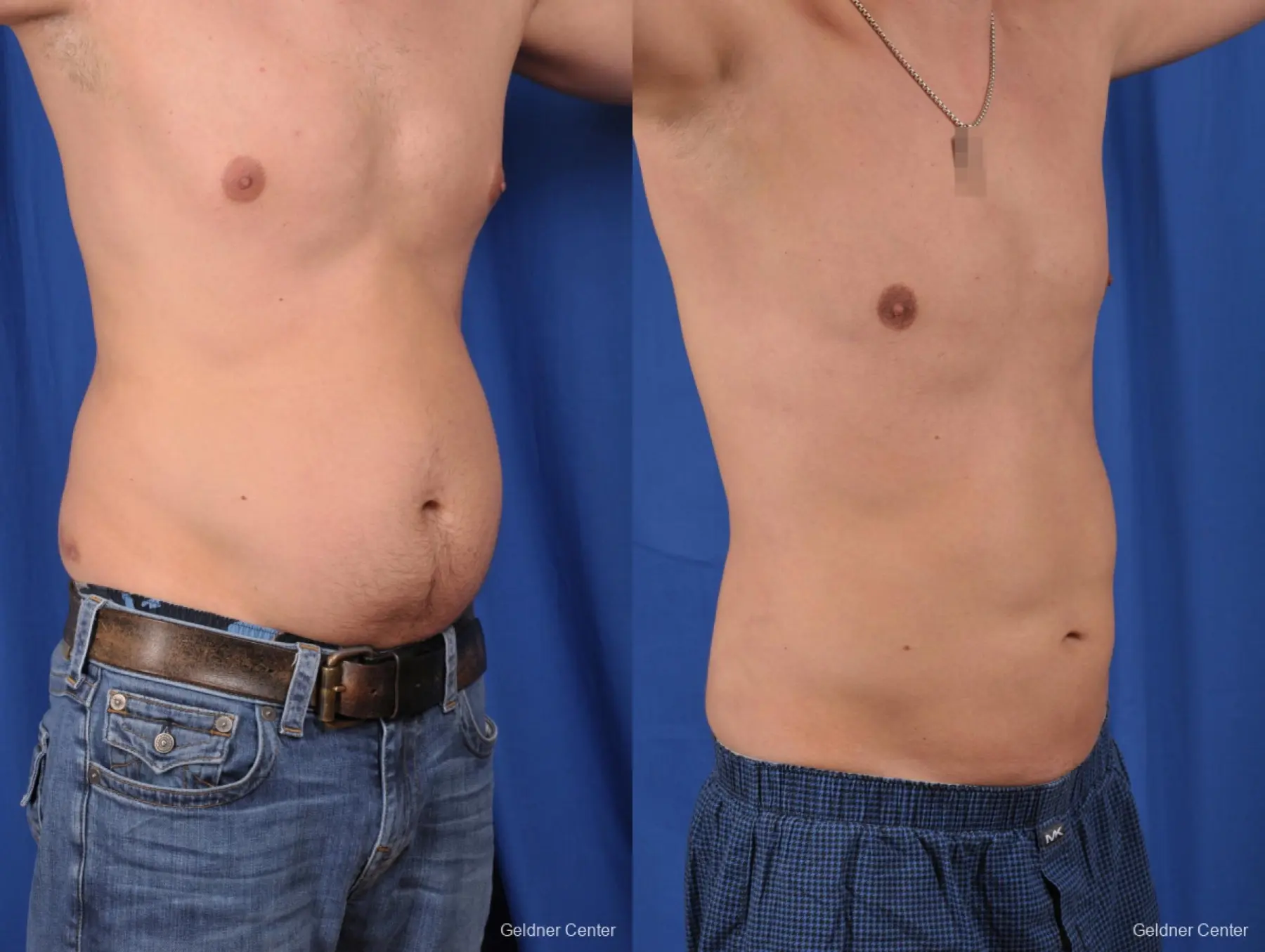 Liposuction For Men: Patient 6 - Before and After 2