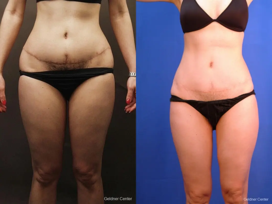 Liposuction: Patient 8 - Before and After 