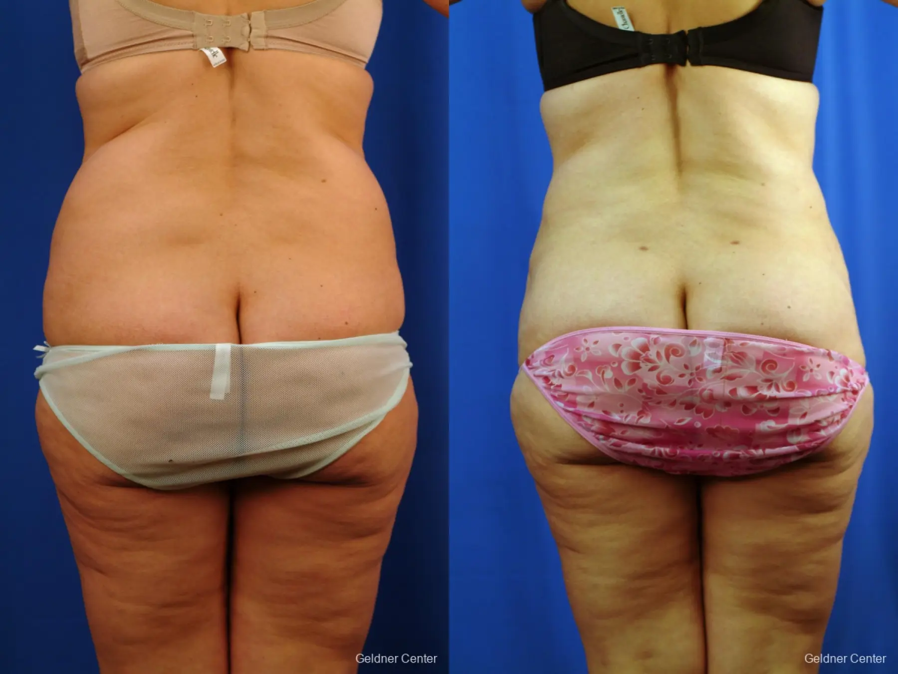 Liposuction: Patient 10 - Before and After 4