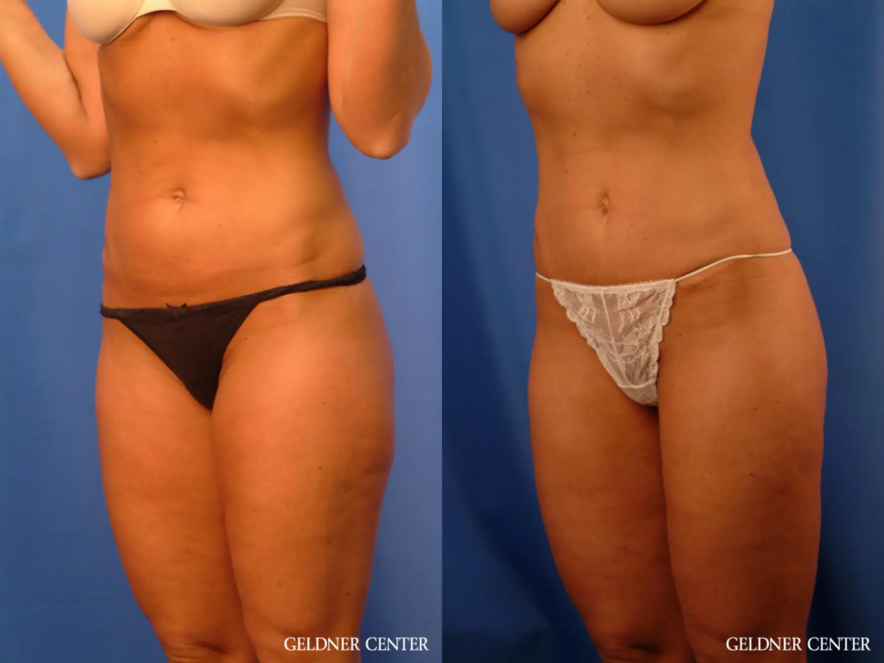Liposuction: Patient 20 - Before and After 5
