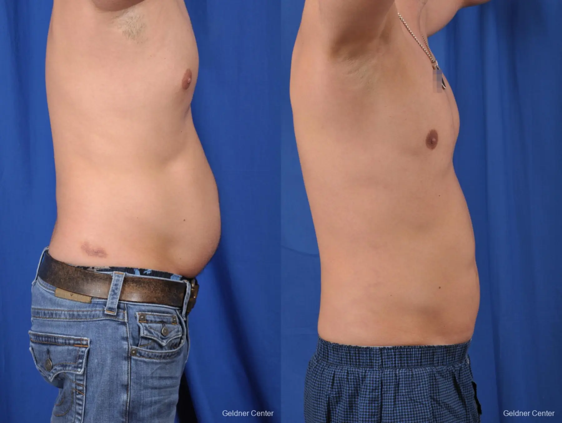 Liposuction For Men: Patient 6 - Before and After 3
