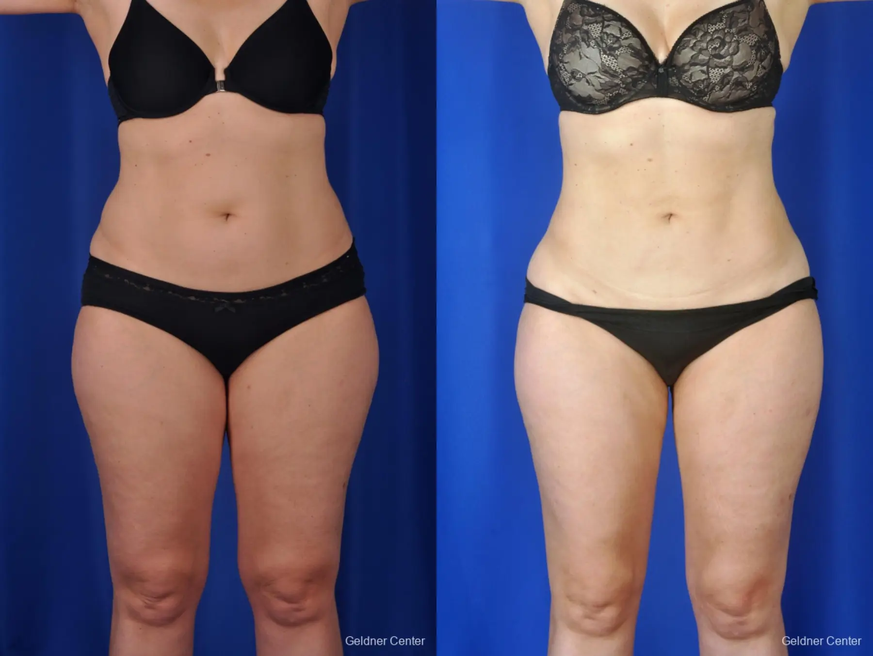 Chicago Lipo Patient - Before and After