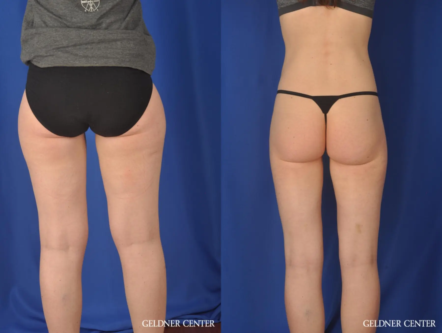 Liposuction: Patient 36 - Before and After 5
