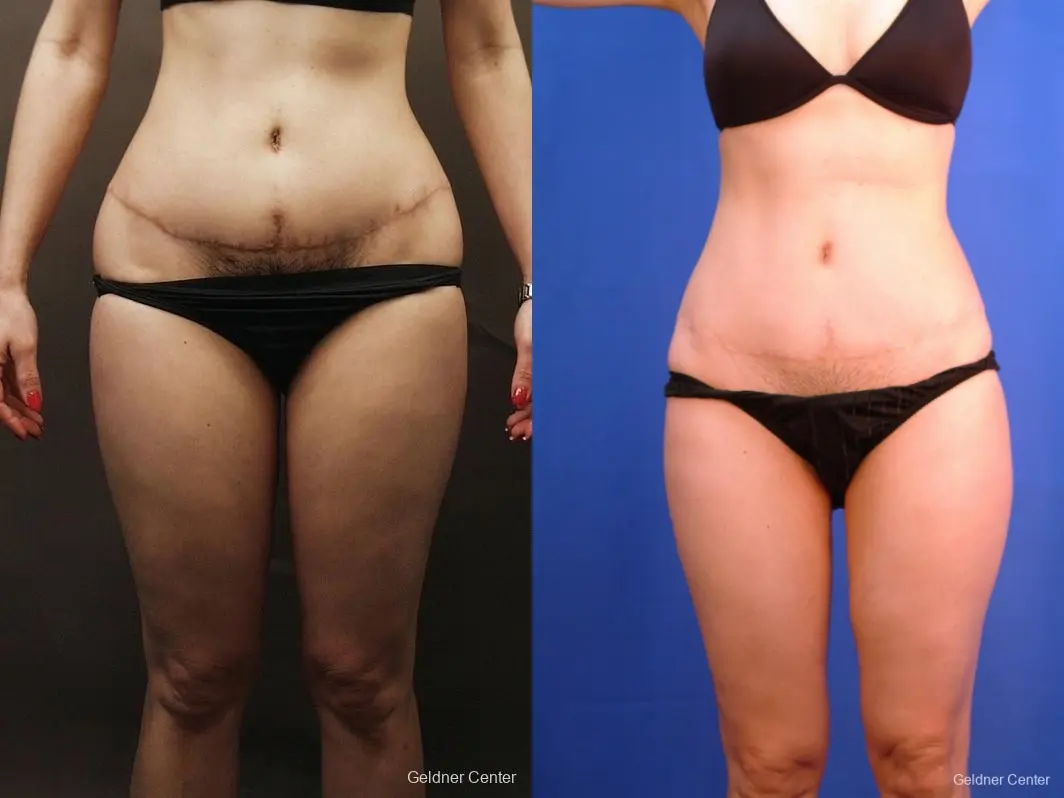 Liposuction: Patient 5 - Before and After 
