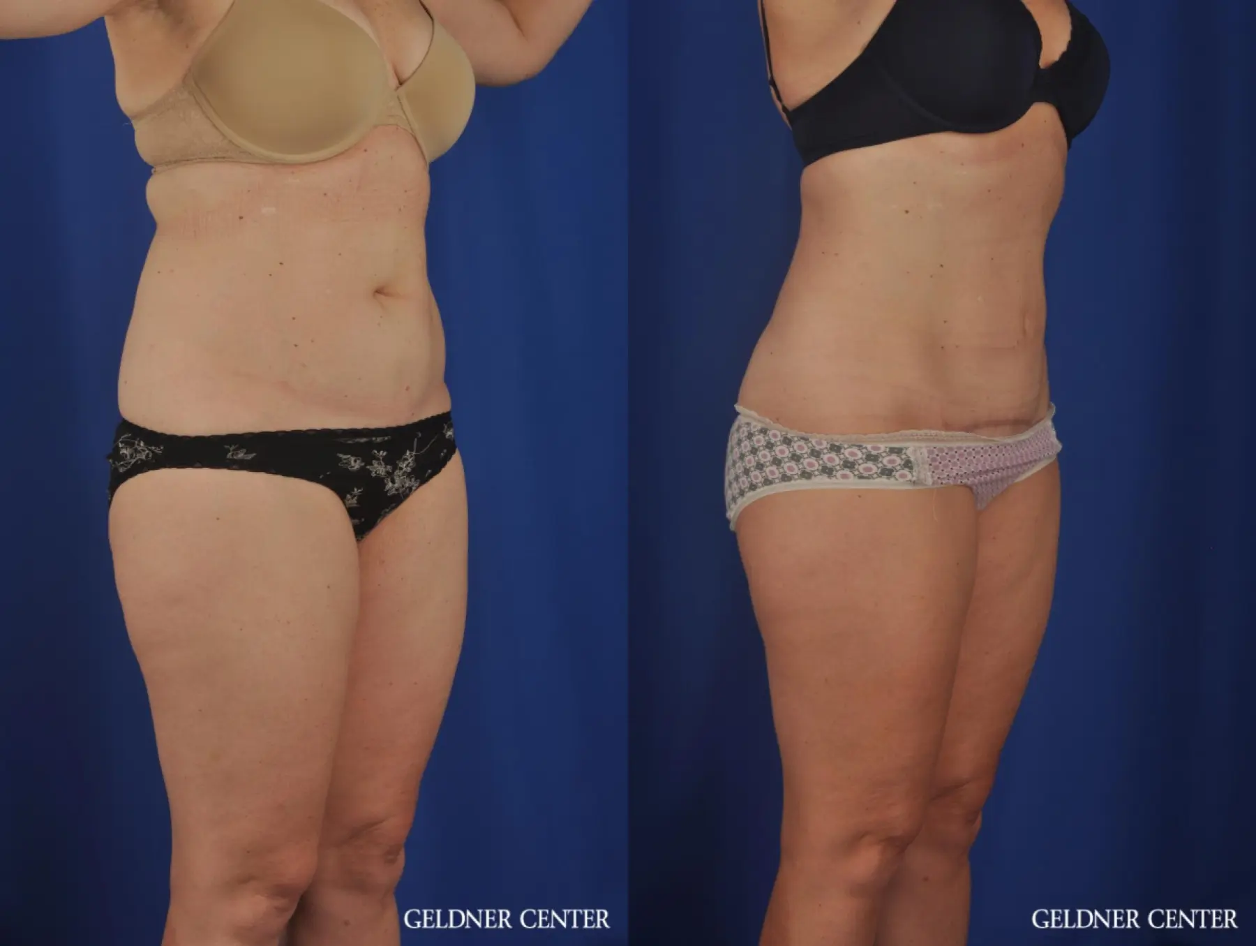 Liposuction: Patient 26 - Before and After 2