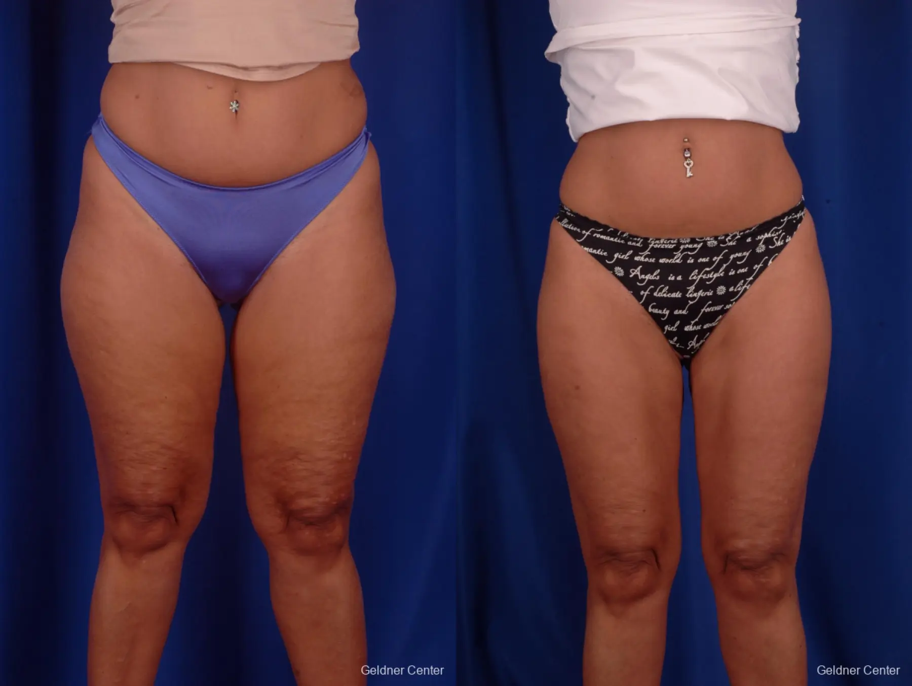 Liposuction: Patient 7 - Before and After 