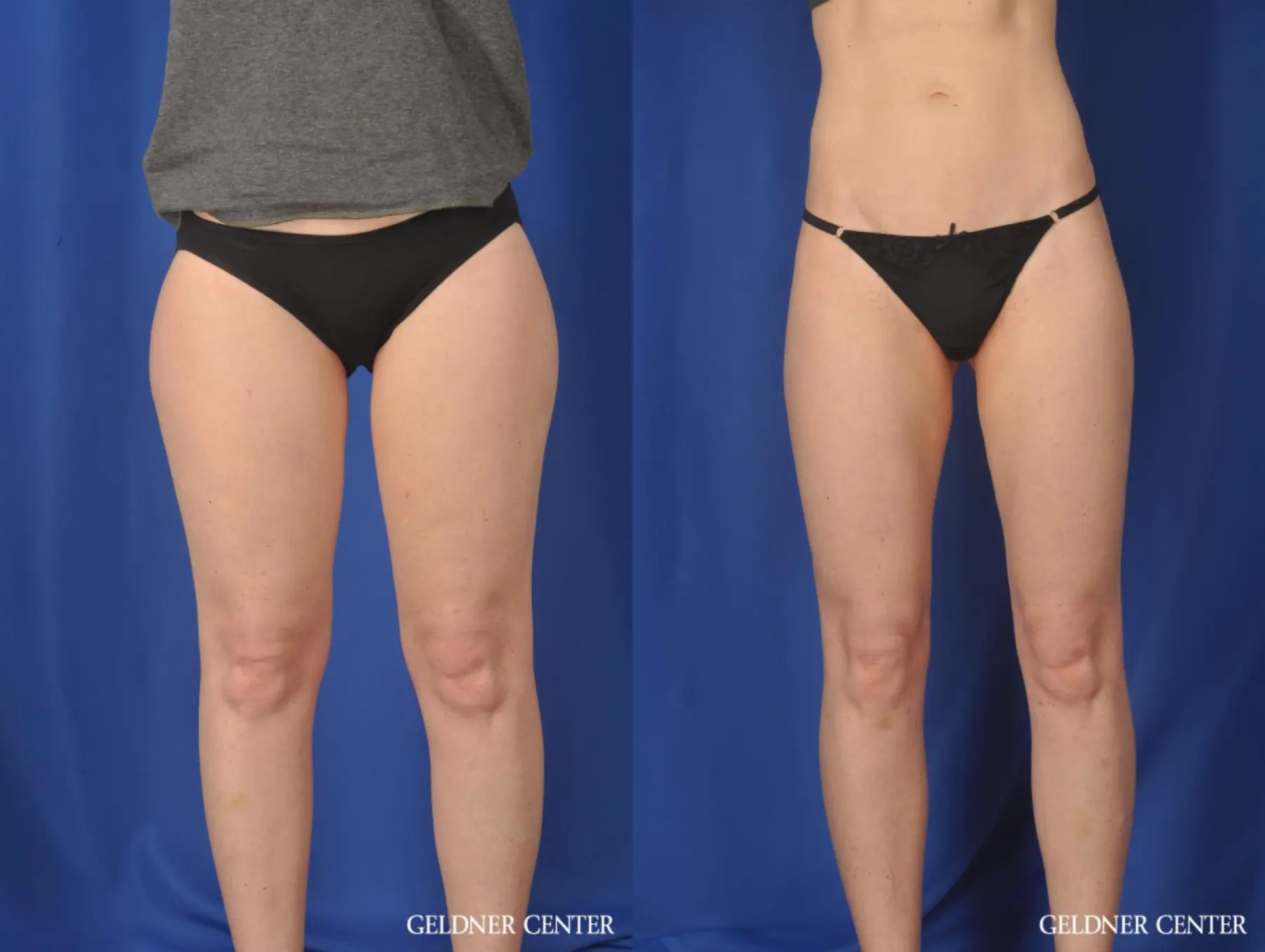 Liposuction: Patient 36 - Before and After 1