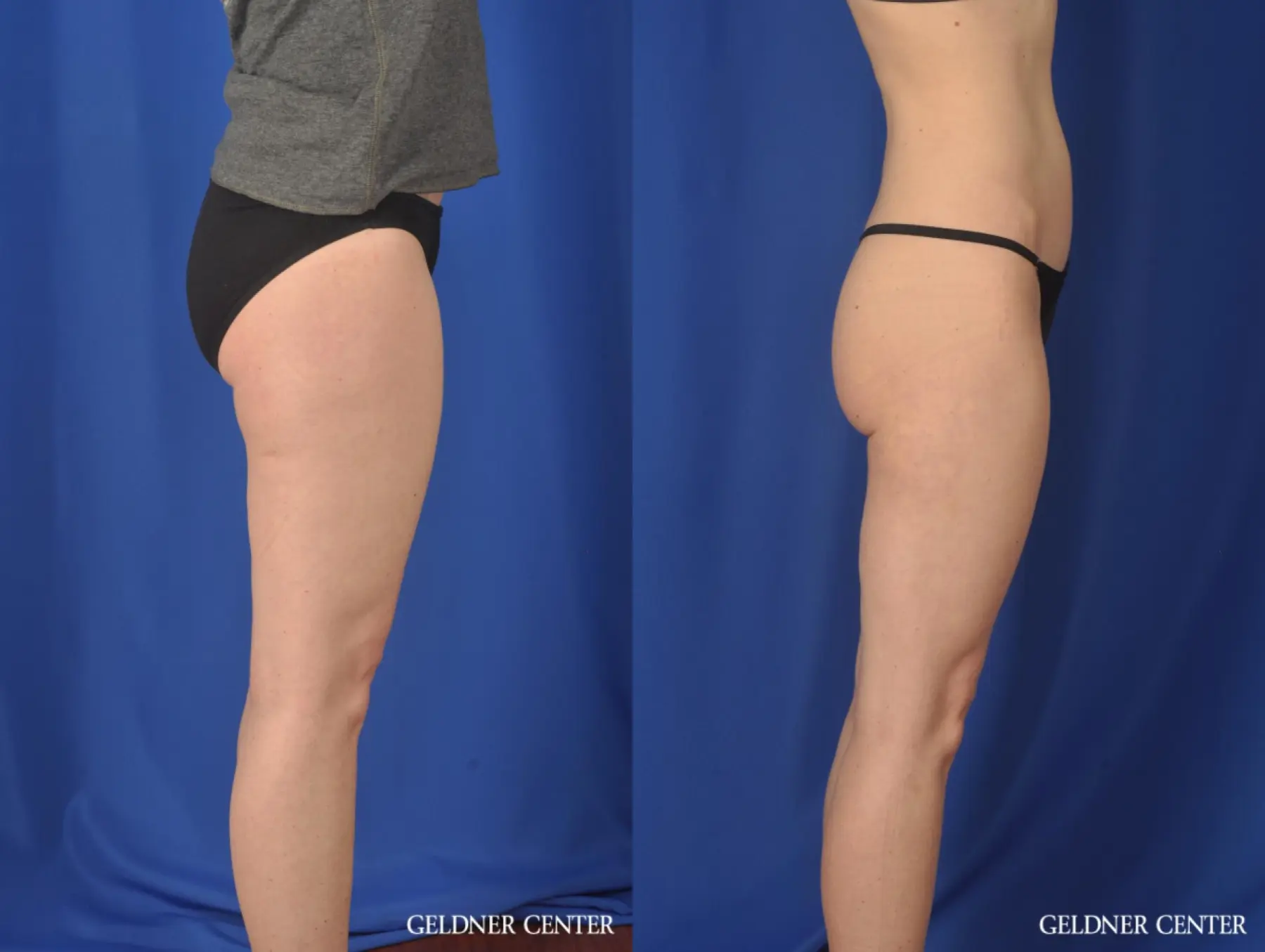 Liposuction: Patient 36 - Before and After 3