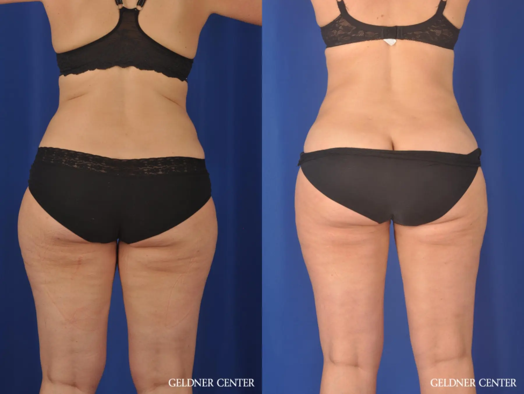 Liposuction: Patient 32 - Before and After 3