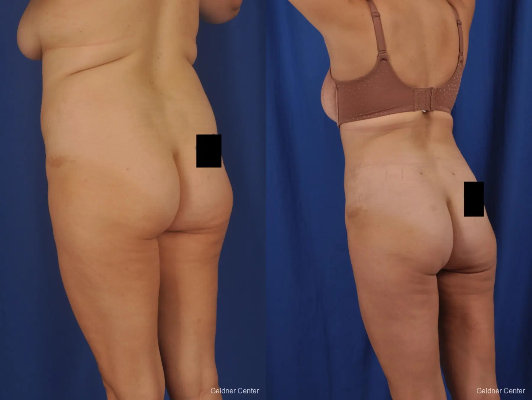 Liposuction: Patient 50 - Before and After 5