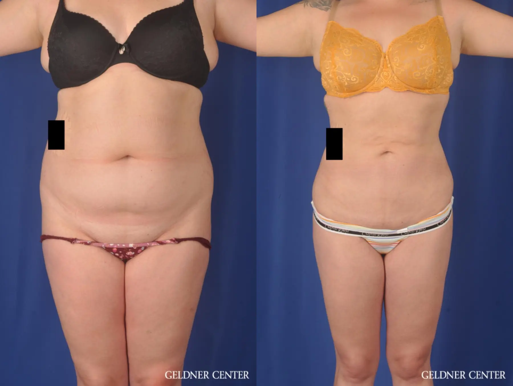 Liposuction: Patient 45 - Before and After 1