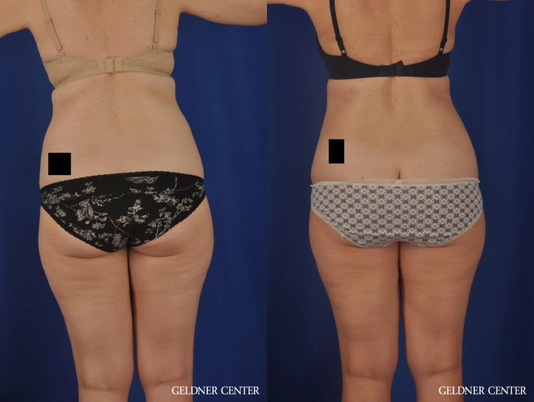 Liposuction: Patient 26 - Before and After 4